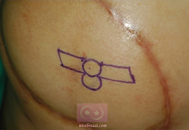 術前設計乳頭位置-T字形局部皮瓣